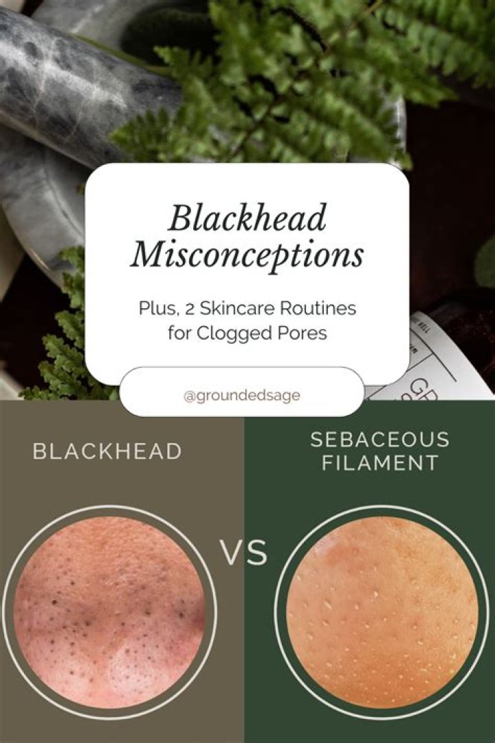 Are blackheads natural?