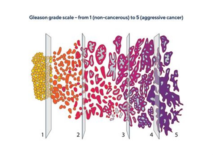 Can a Gleason 7 metastasize?