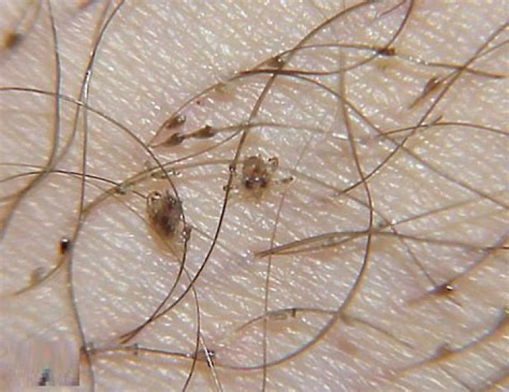Can you see pubic lice?