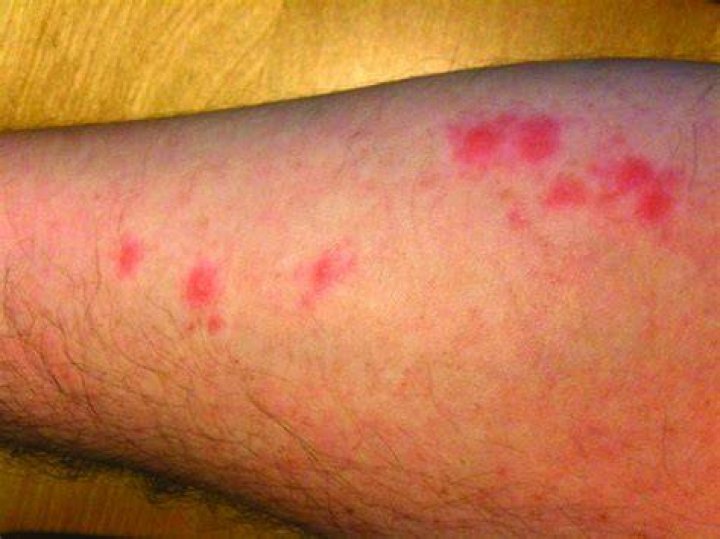 Do bed bugs bite on the legs?