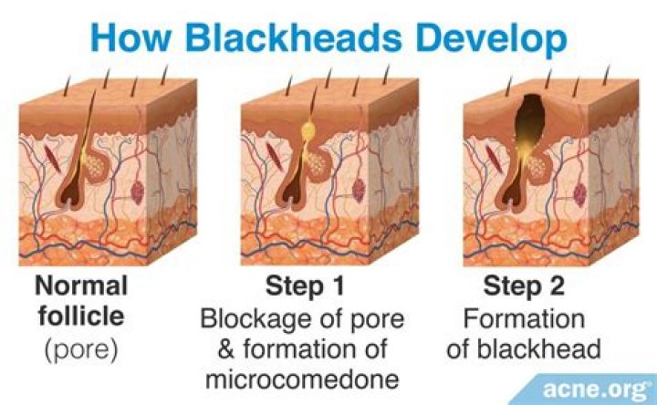 Do blackhead holes go away?