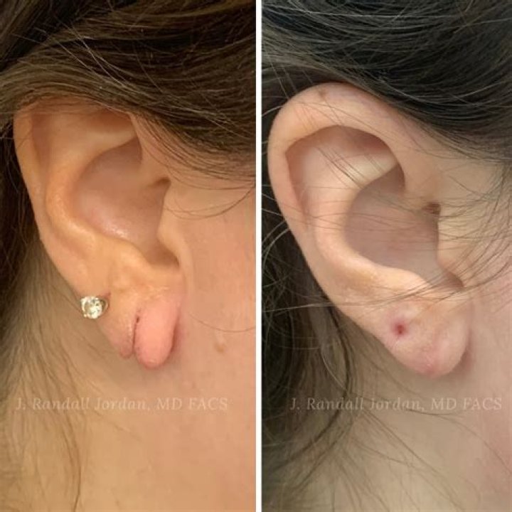 Do nose rings heal faster than studs?