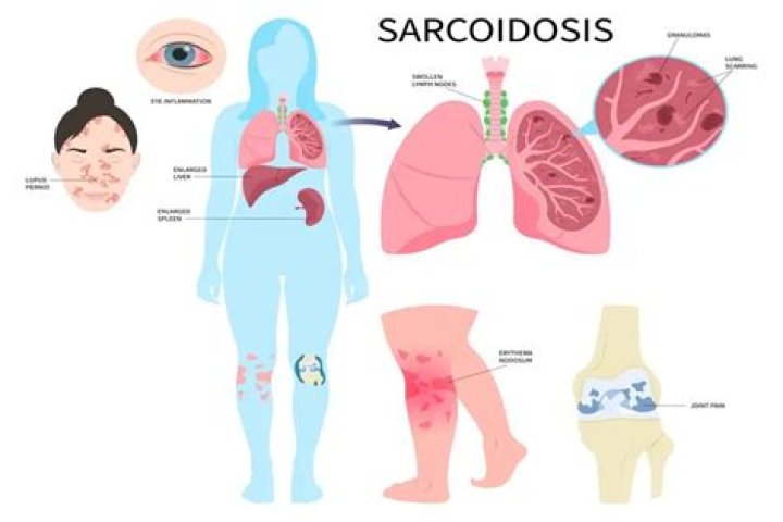Does sarcoidosis cause phlegm?