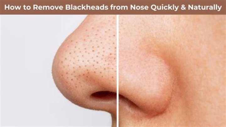 How do you grit a blackhead?