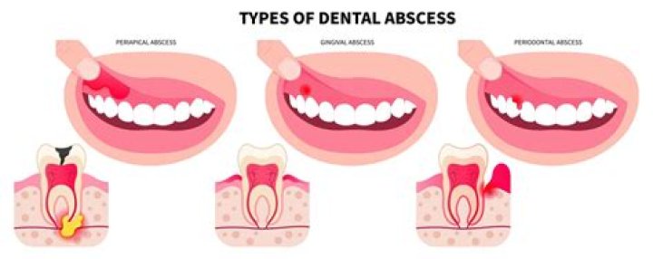 How long can you leave an abscess untreated?