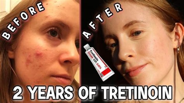 How long does it take tretinoin .025 to work?