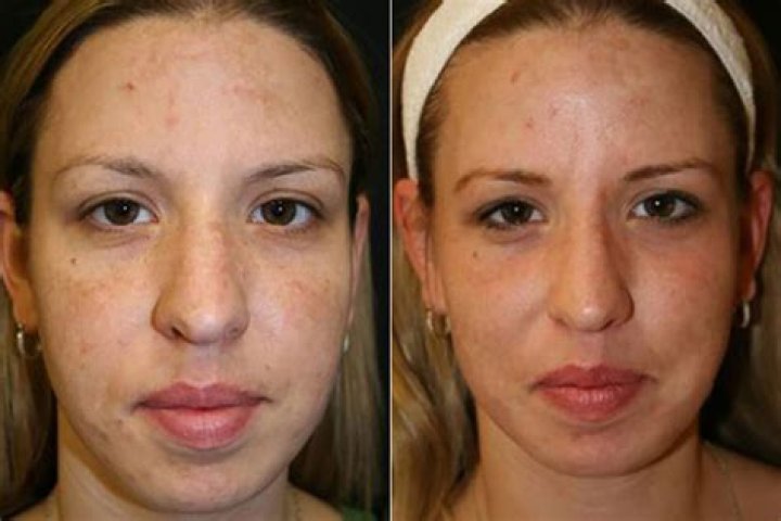 Is Fraxel the same as fractional laser?