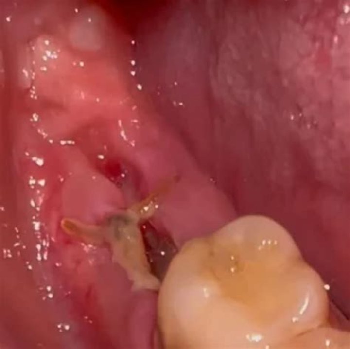 Is it OK to swallow blood after tooth extraction?