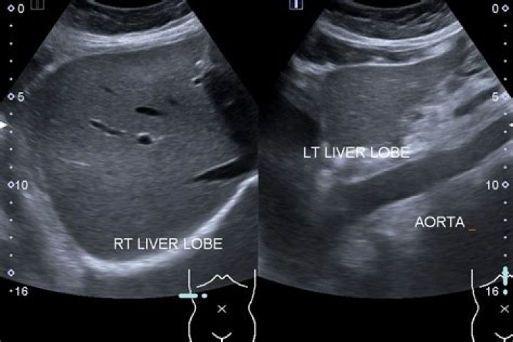 Is MRI better than ultrasound for liver?