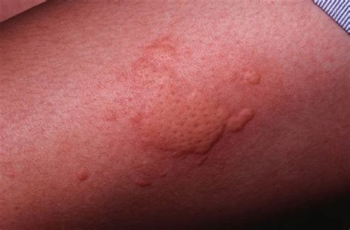 What are skin hives?