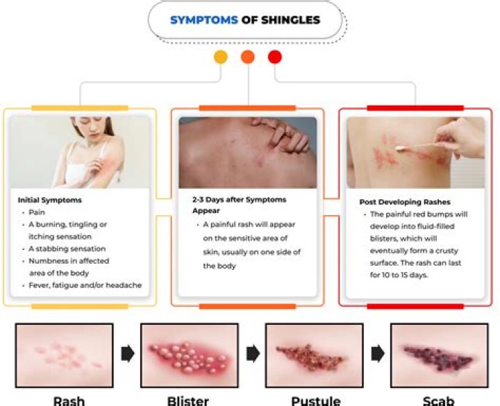 What are the final stages of shingles?
