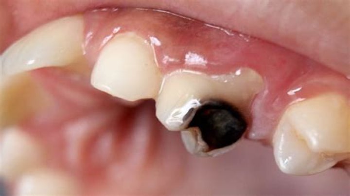 What causes teeth to turn black?