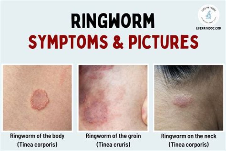 What does a ringworm look like?
