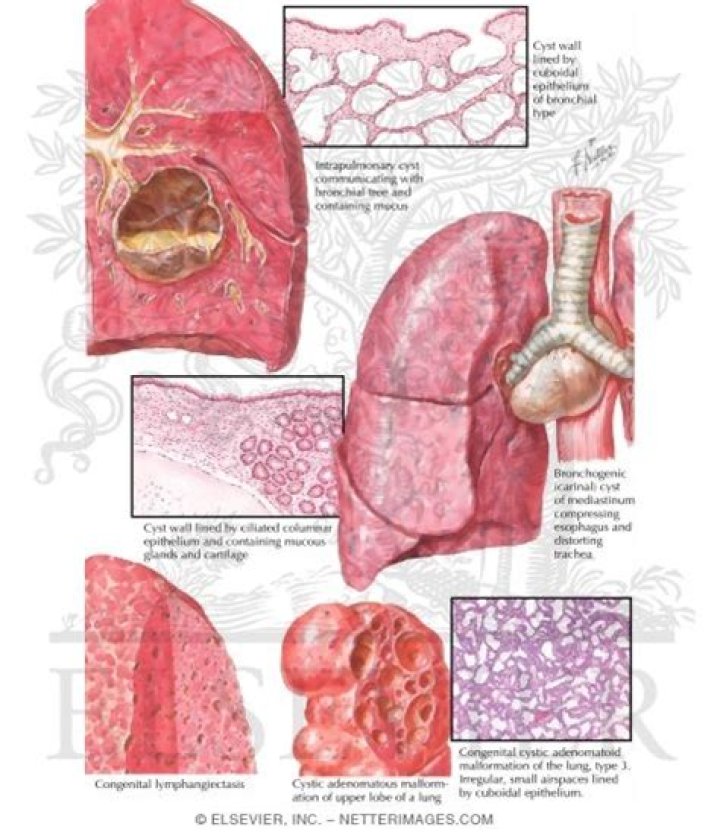 What is a bronchogenic cyst?