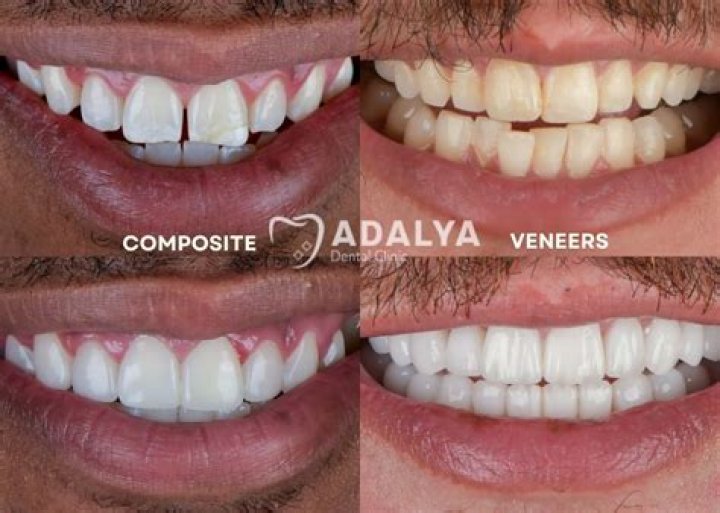 What is a cheaper option than veneers?