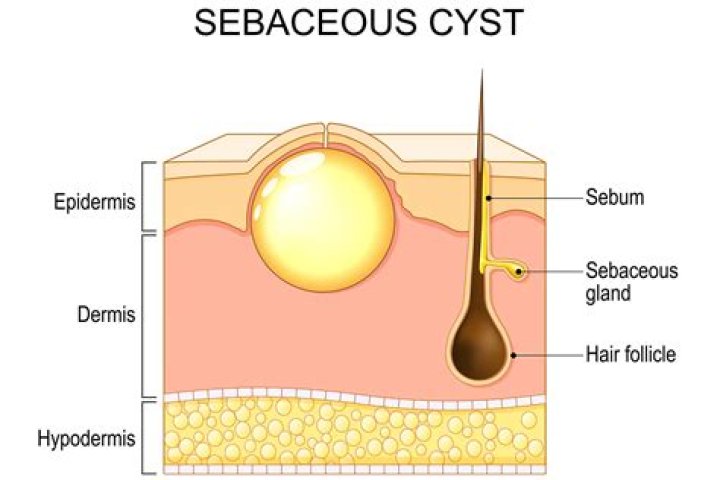 What is a pebble cyst?