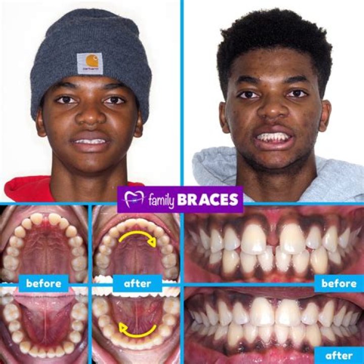 Why do braces take 2 years?