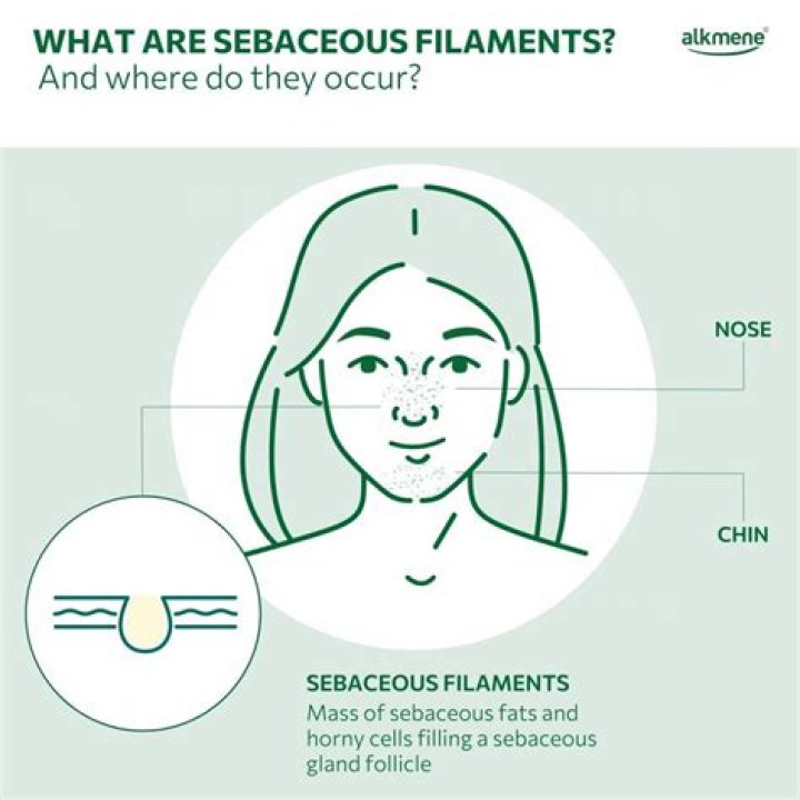 Why do I have so many sebaceous filaments?