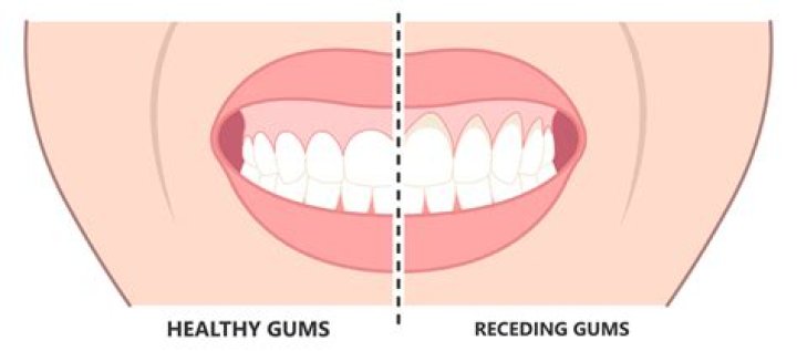 Why is my gum separating from my tooth?